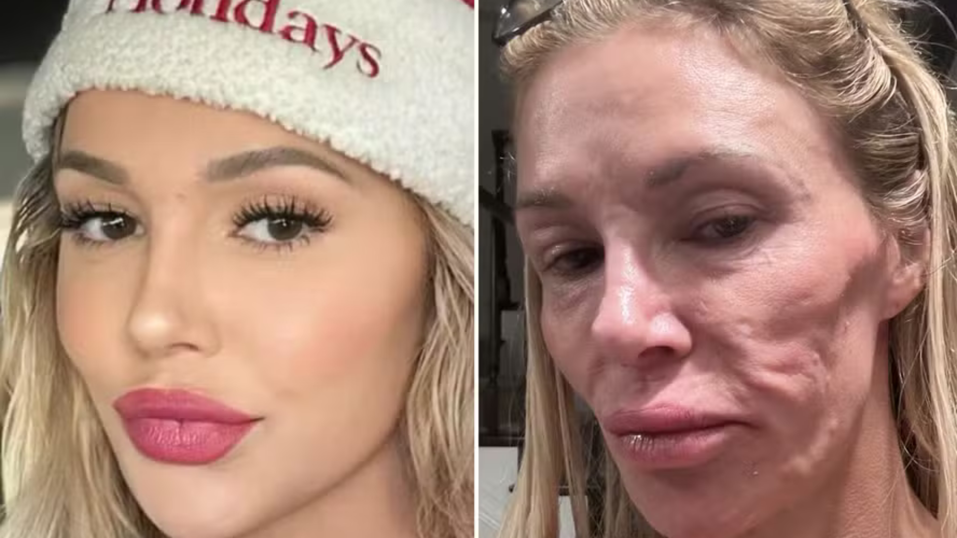 Ex-modelo, Brandi Glanville mostra rosto ‘derretido’: ‘Dizem que tem um parasita’