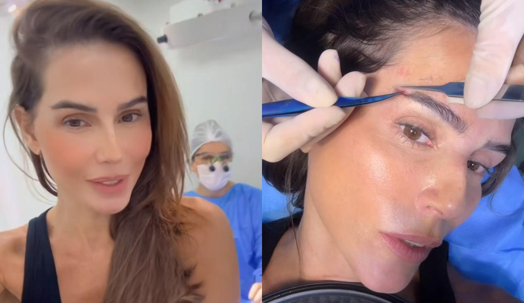 Deborah Secco mostra cirurgia de transplante de sobrancelha e especialista reforça cuidados: ‘Fundamental’