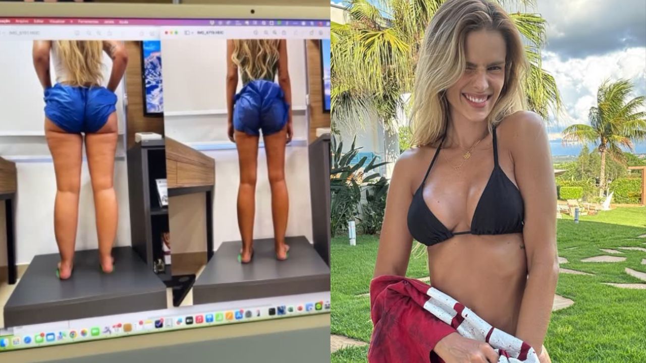 Yasmin Brunet celebra resultado de tratamento expõe antes e depois: ‘Me salvou’