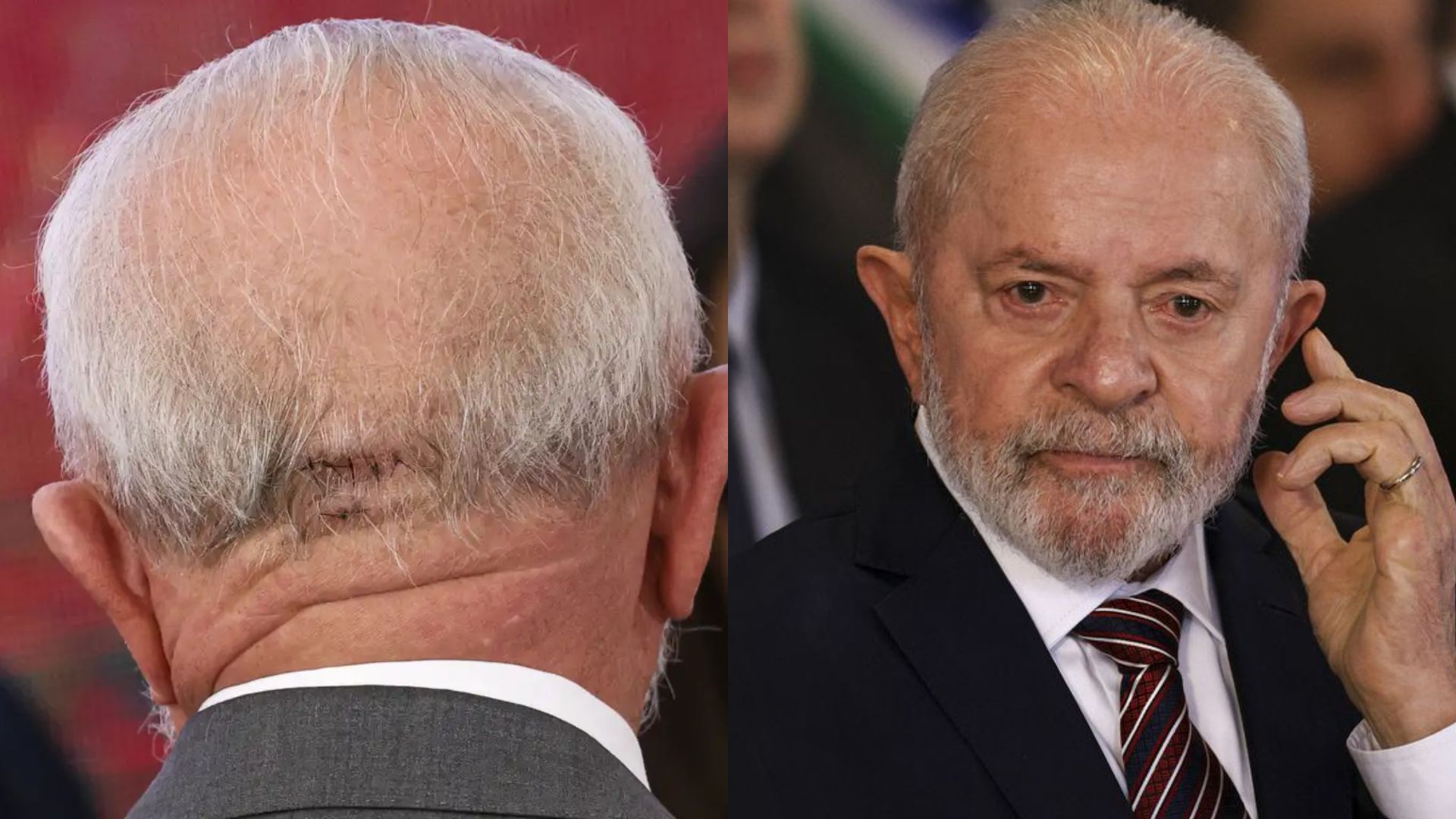 Ainda na UTI: Médicos atualizam sobre estado de saúde de Lula após cirurgia de emergência