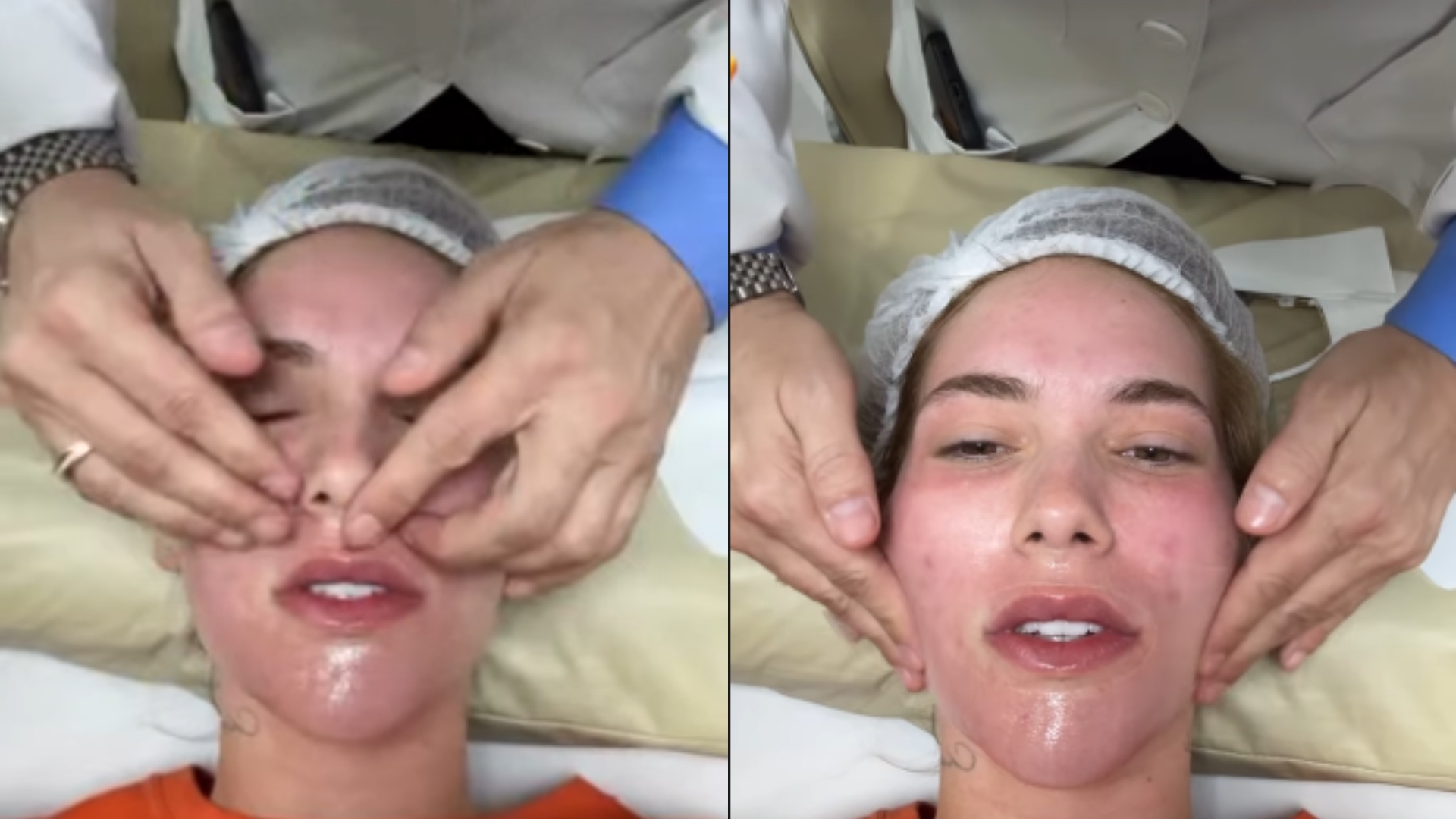 Virginia exibe rosto inchado e manchas vermelhas após procedimento: ‘Não se assustem’