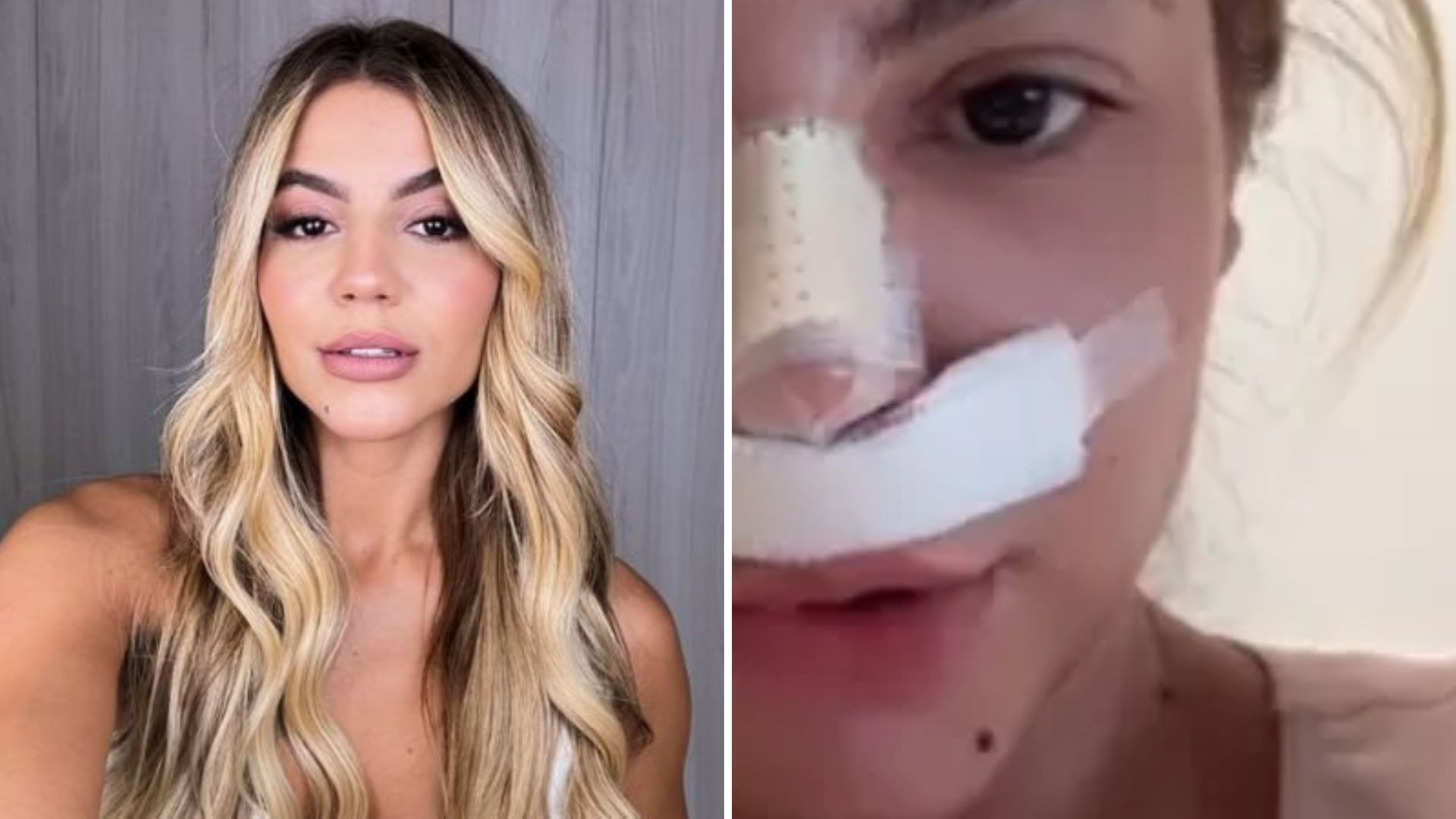 Ex-BBB Hariany surge irreconhecível após três cirurgias: ‘Sofri pressão estética’