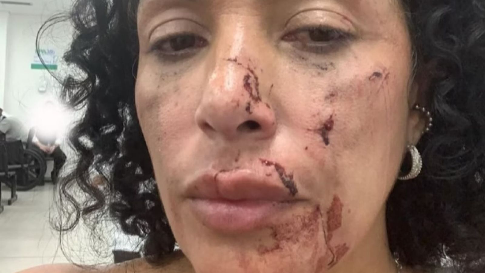 Mulher denuncia ter sido agredida por dono de bar com garrafa de vidro