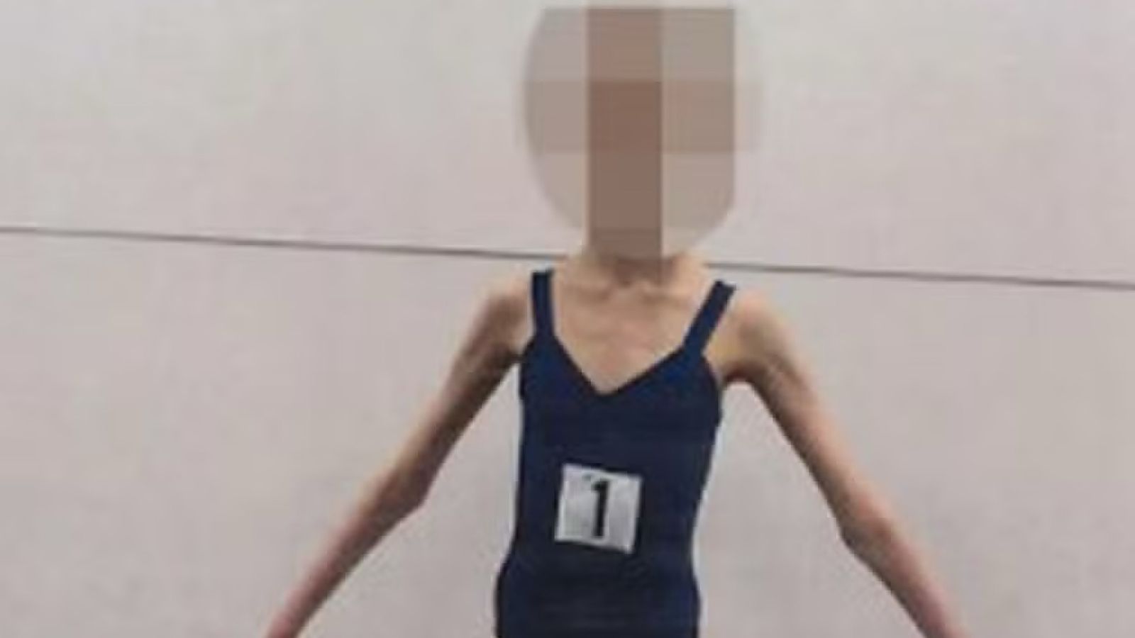 Pais de jovem bailarina são condenados por permitirem que a filha chegasse a pesar apenas 27 quilos