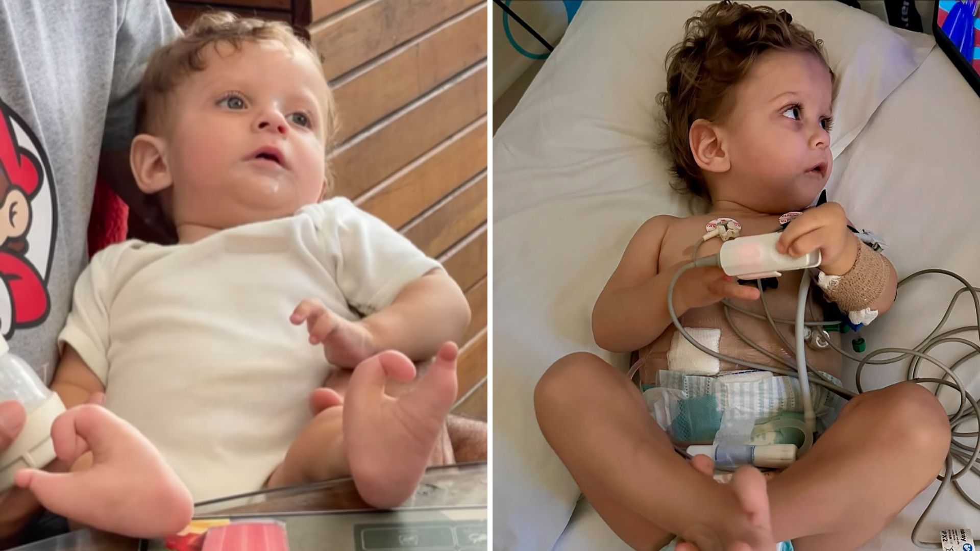 Bebê enfrenta 20 horas de diálise por dia devido a falta de transplante; entenda