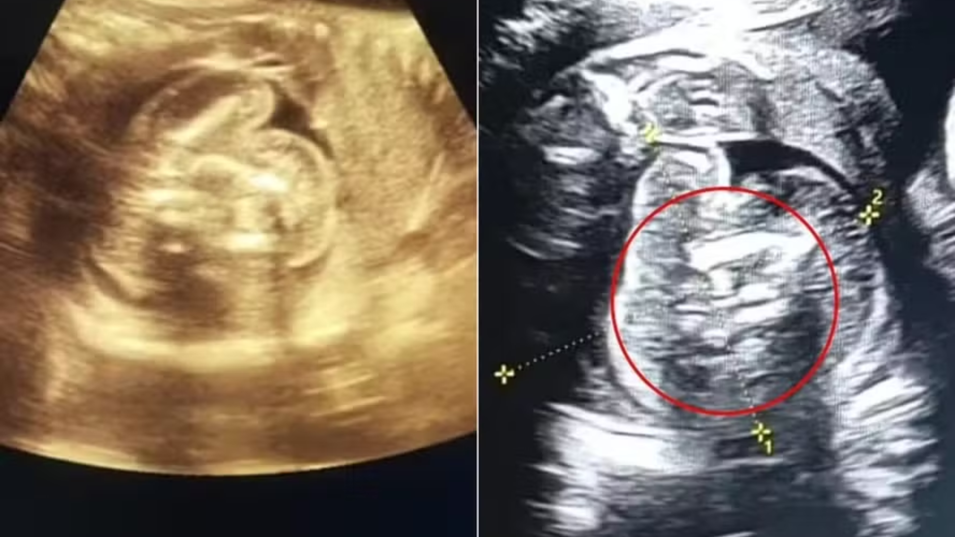 Caso raro: Bebê nasce com dois fetos dentro da barriga que deveriam ser seus irmãos