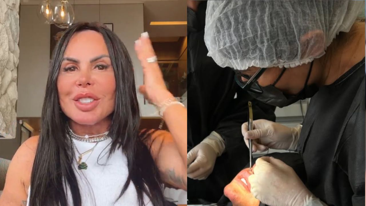 Gretchen passa por cirurgia para retirar substância perigosa dos lábios: ’20 anos’