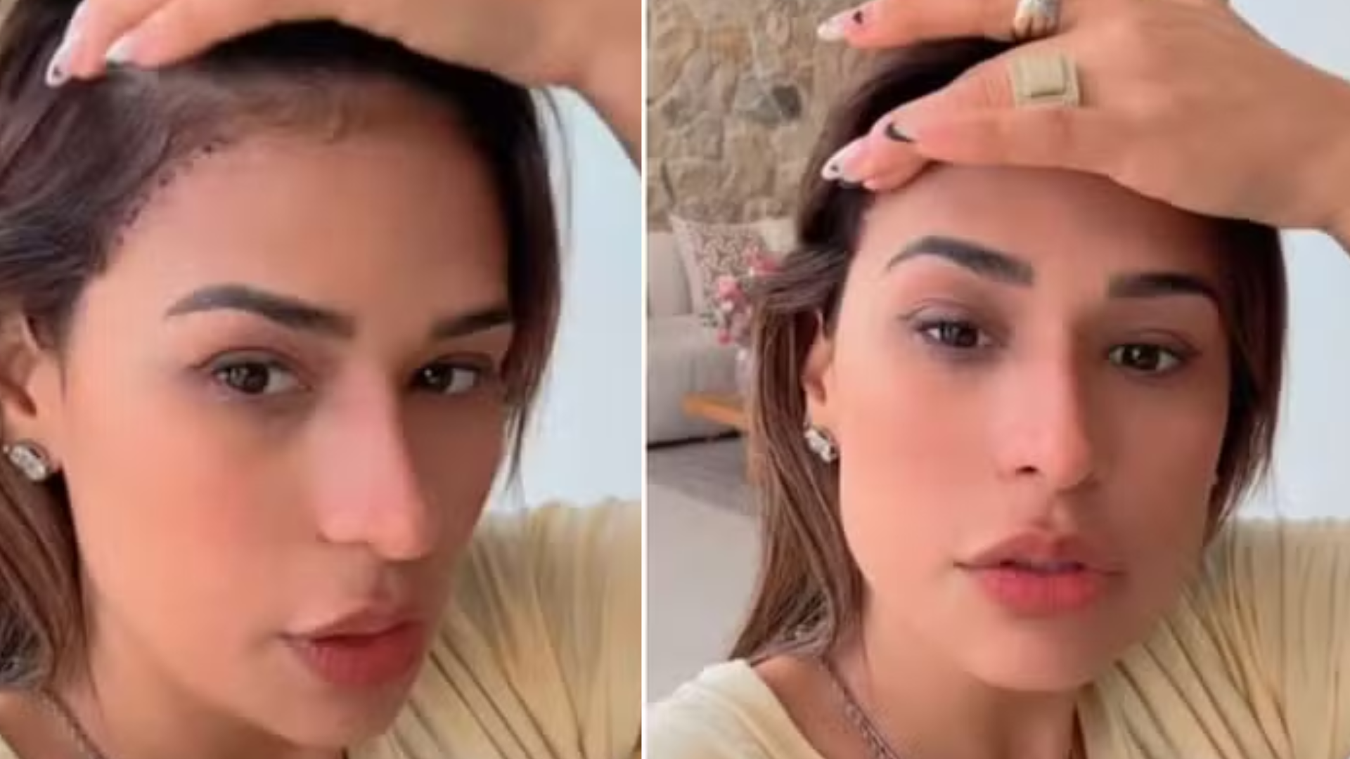 Simone Mendes passa por cirurgia no rosto e revela motivo: ‘Eu tinha’