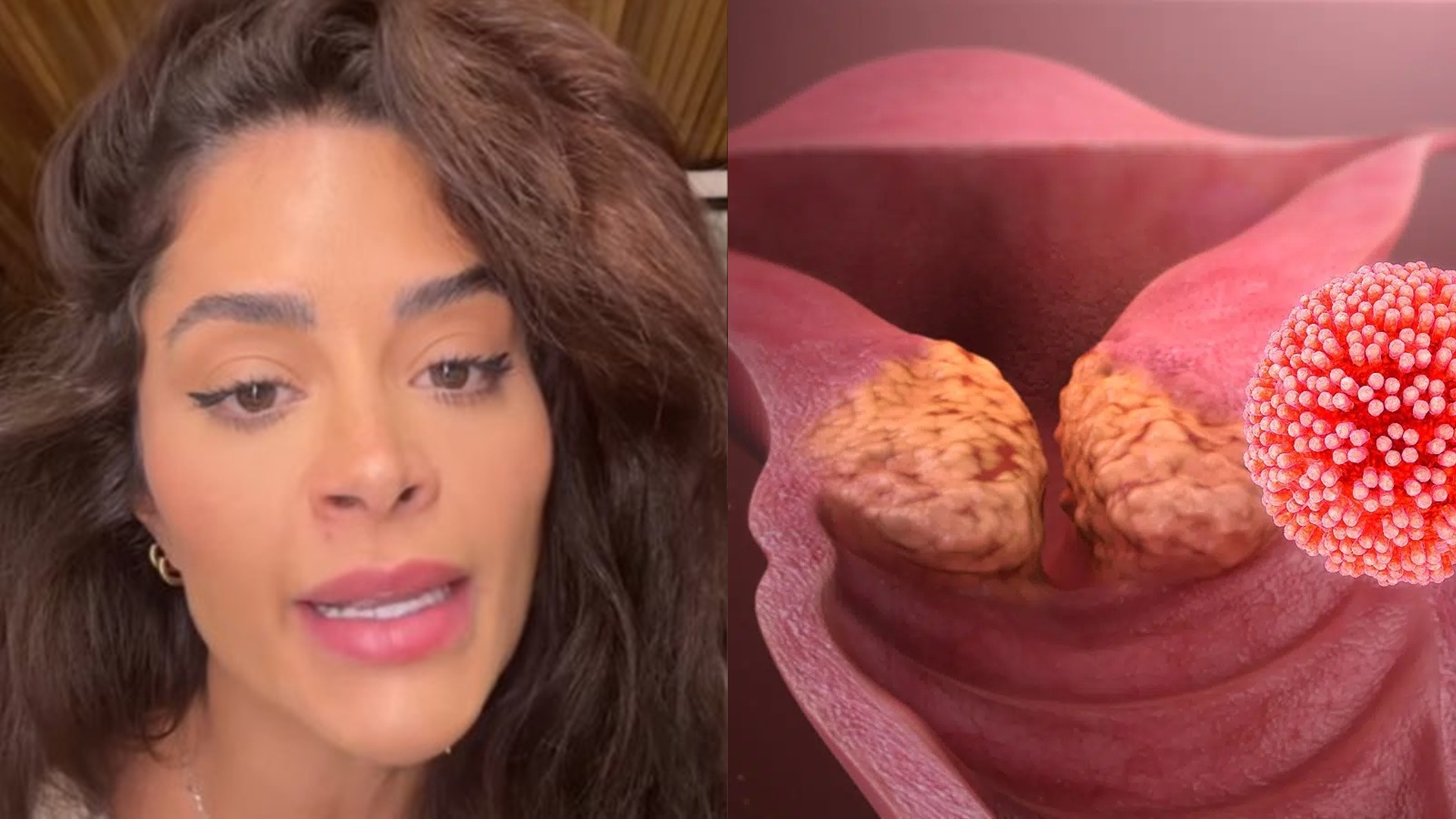 O que é HPV? Entenda a doença que causou lesão pré-cancerígena em Aline Campos
