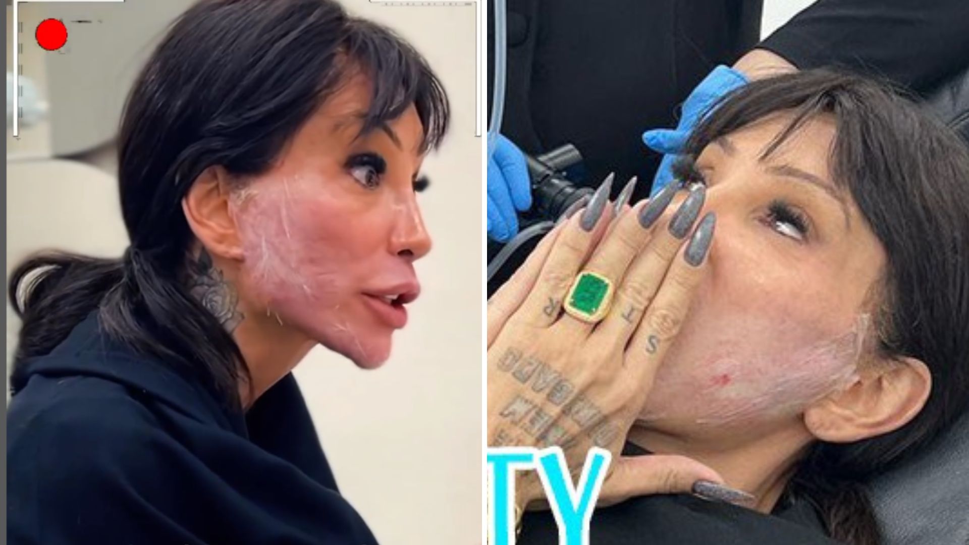 Maya Massafera faz ‘carboxiterapia’ após mais de 20 procedimentos: saiba como funciona