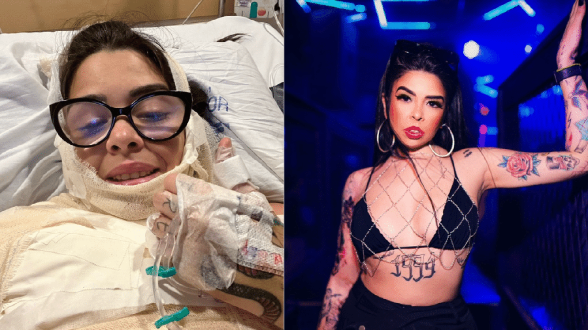 Panela de fondue explode e queima DJ: ‘Meu corpo em chamas e pele na mão’