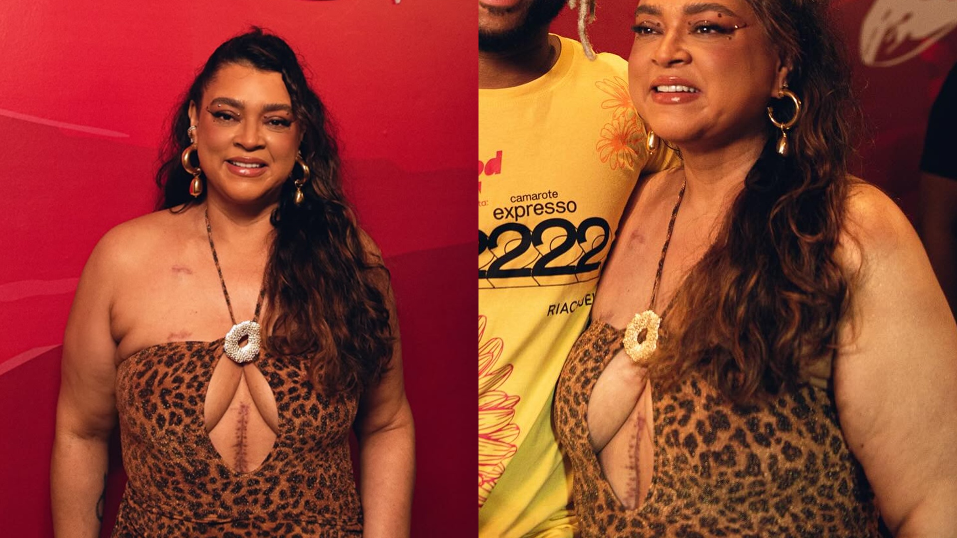 Lutando contra câncer, Preta Gil se explica por exibir cicatrizes no Carnaval: ‘Tô viva’