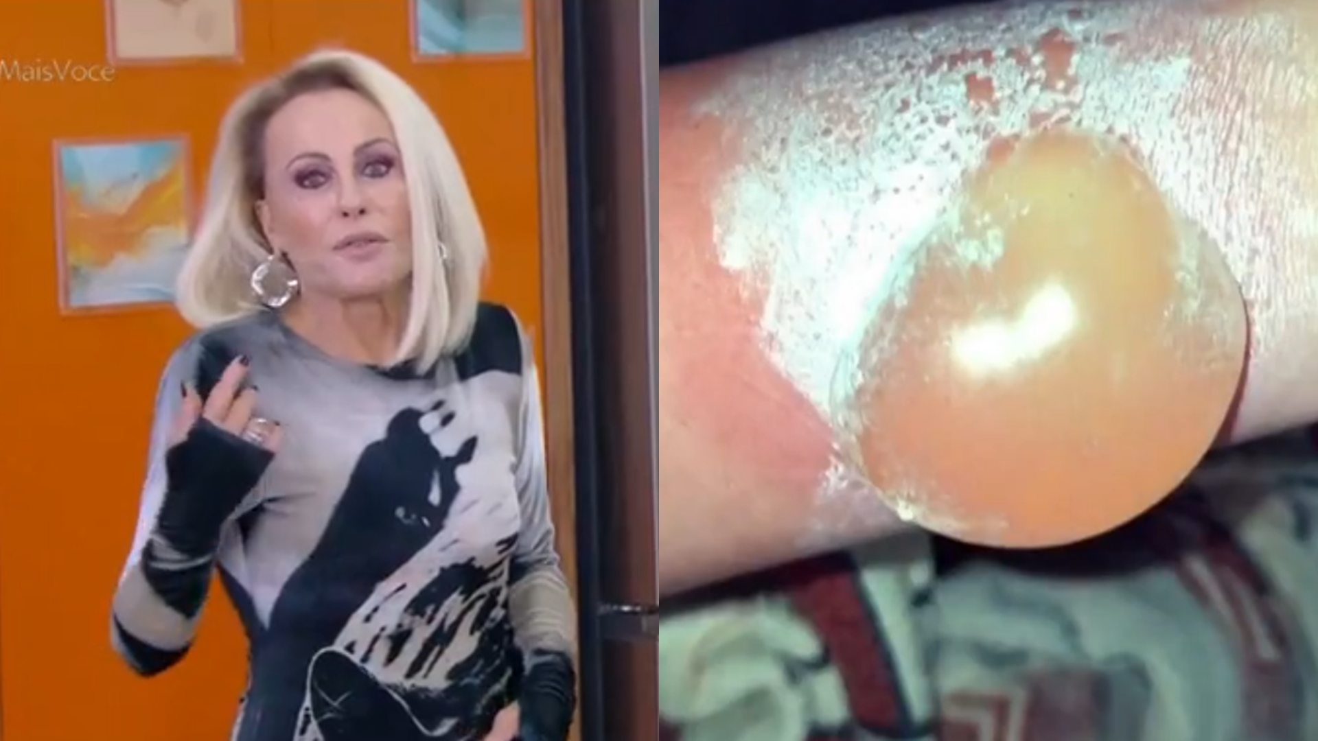 Ana Maria Braga assusta ao mostrar bolha causada em acidente doméstico: ‘Ninguém tá livre’