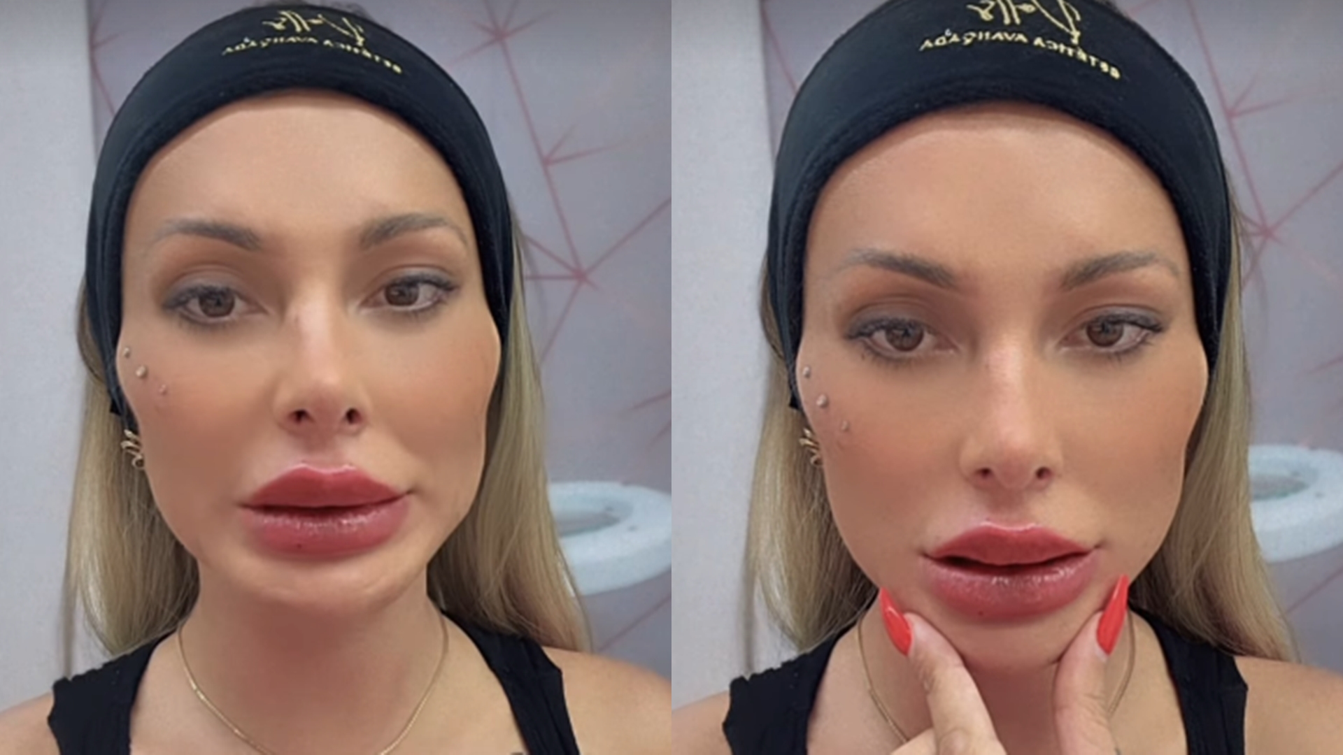 Andressa Urach assusta ao surgir com boca gigante: ‘Tô amando’