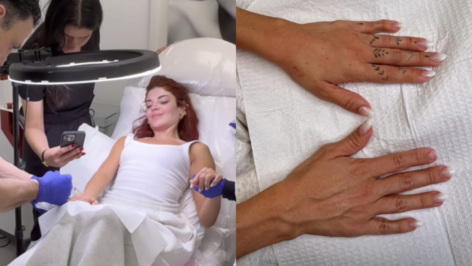 Médica alerta sobre riscos de harmonização das mãos de Gkay: ‘Hematomas’
