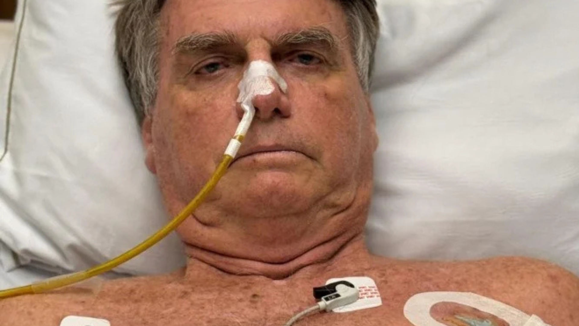 Ex-presidente Jair Bolsonaro apresenta melhora e tirará a sonda nos próximos dias