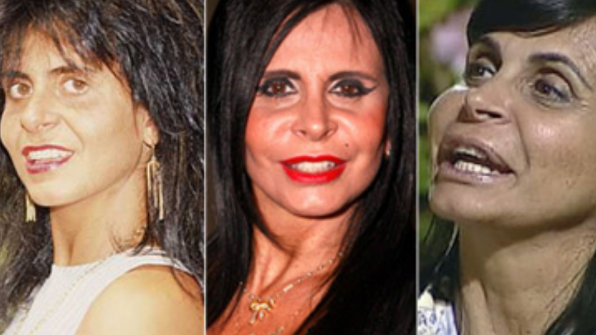 Antes e depois: 5 famosos que fizeram cirurgia plástica e mudaram drasticamente