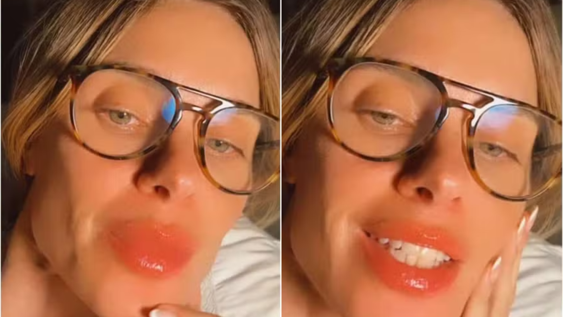 Carolina Dieckmann sofre reação alérgica após voo: ‘Triplicou de tamanho’