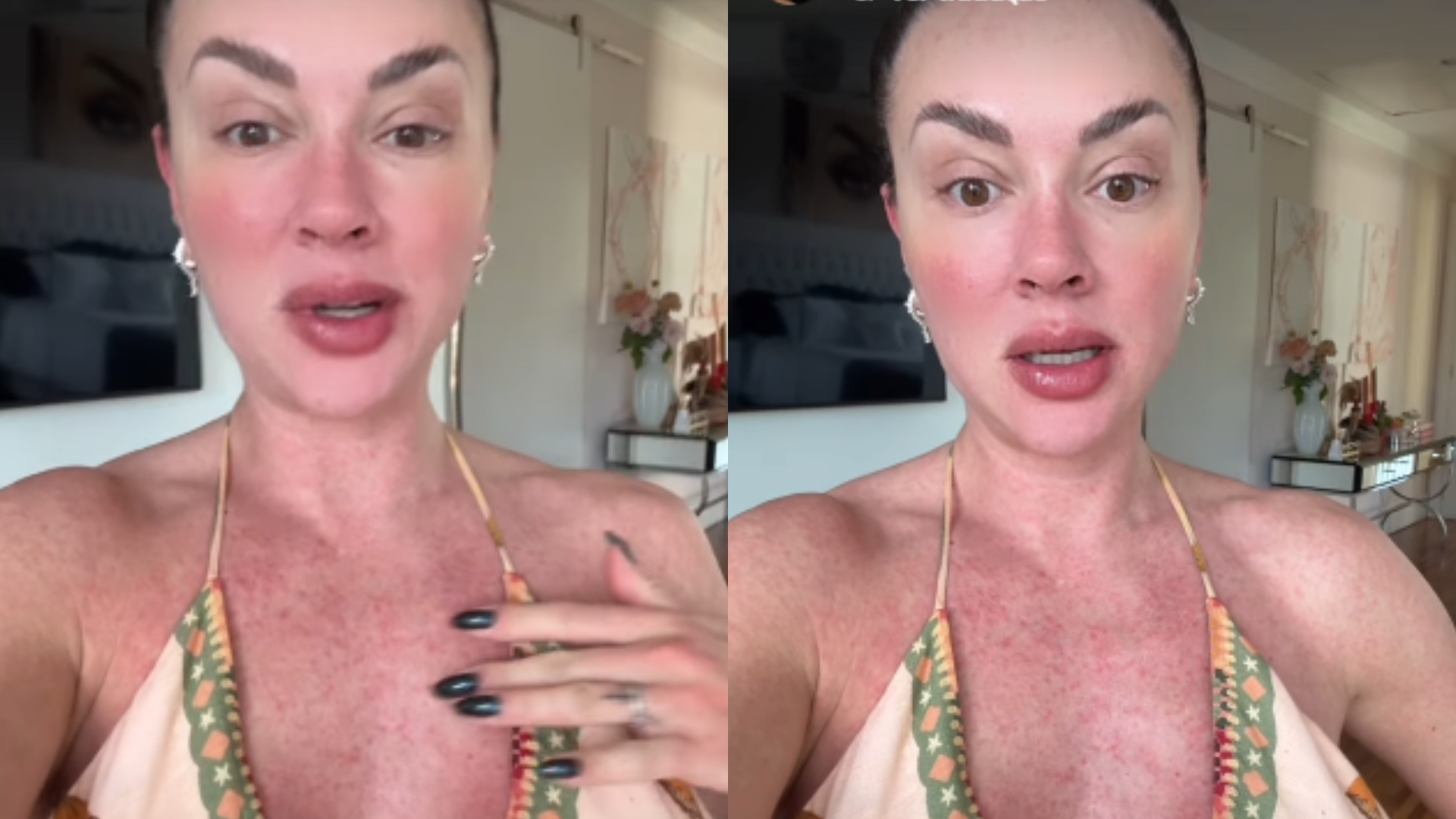 Diagnosticada com dengue, Juju Salimeni se apavora com manchas na pele: ‘Tomei um susto’