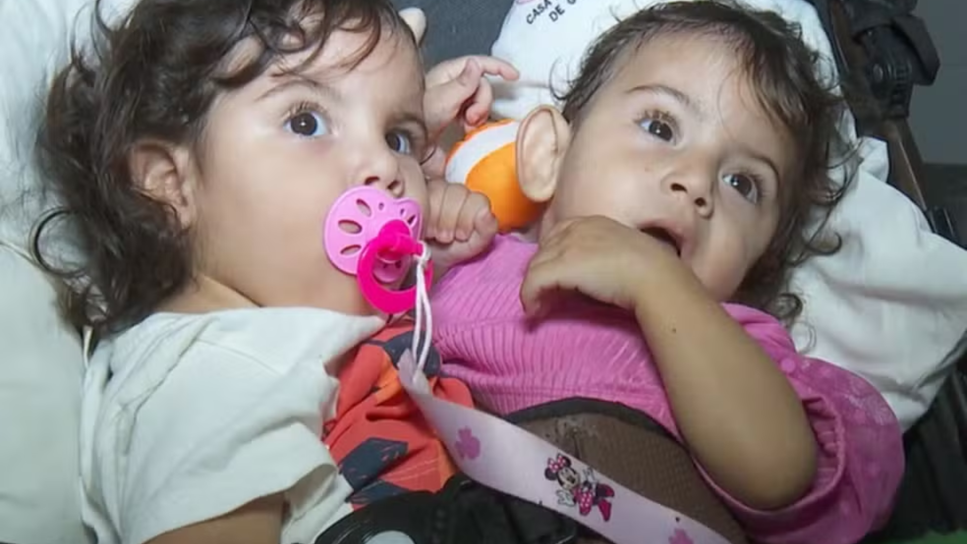 Irmã gêmea de siamesa que morreu após cirurgia está em estado grave no hospital