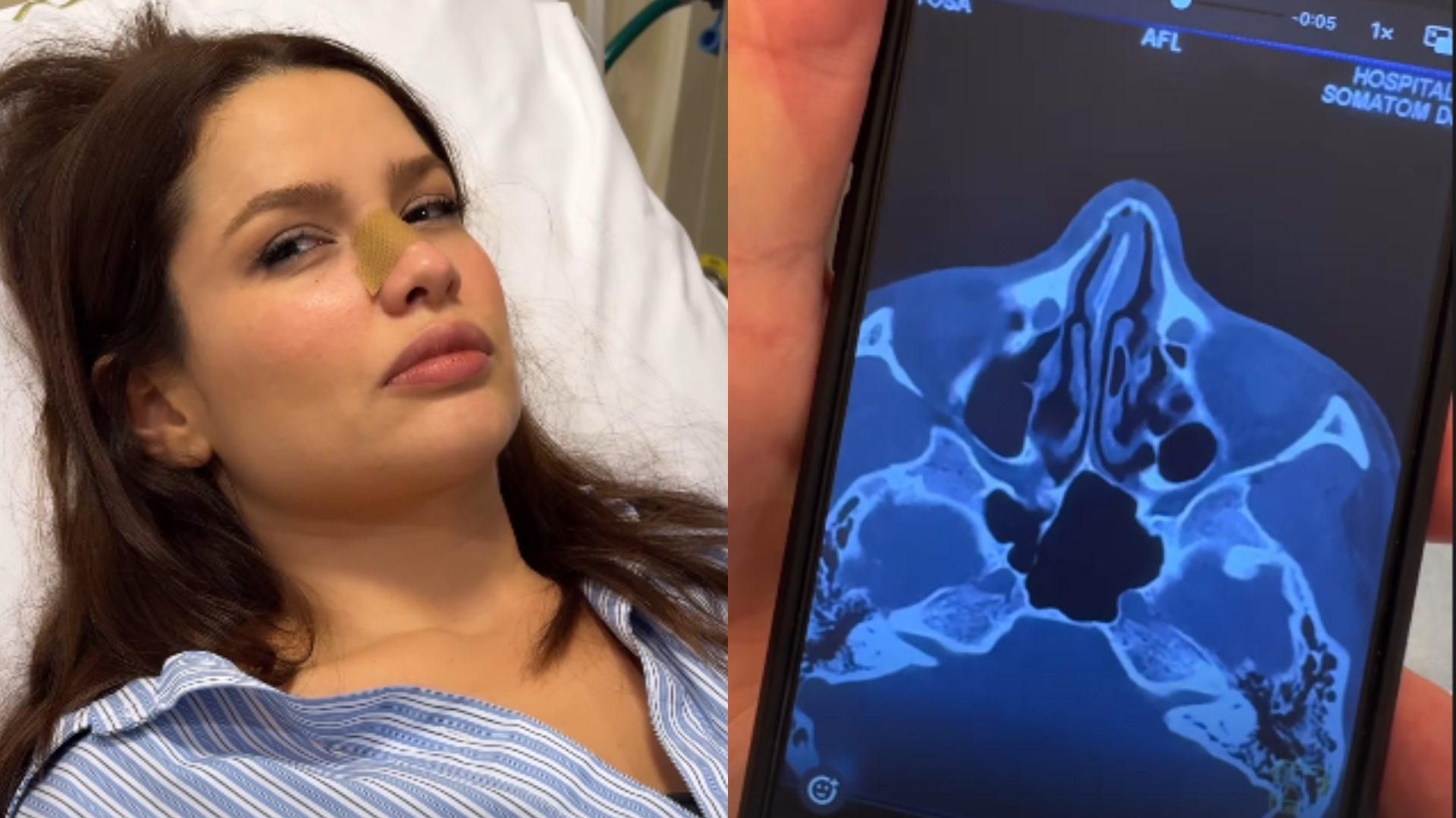 Juliette sofre acidente doméstico e fratura o nariz: ‘Já chorei que só’