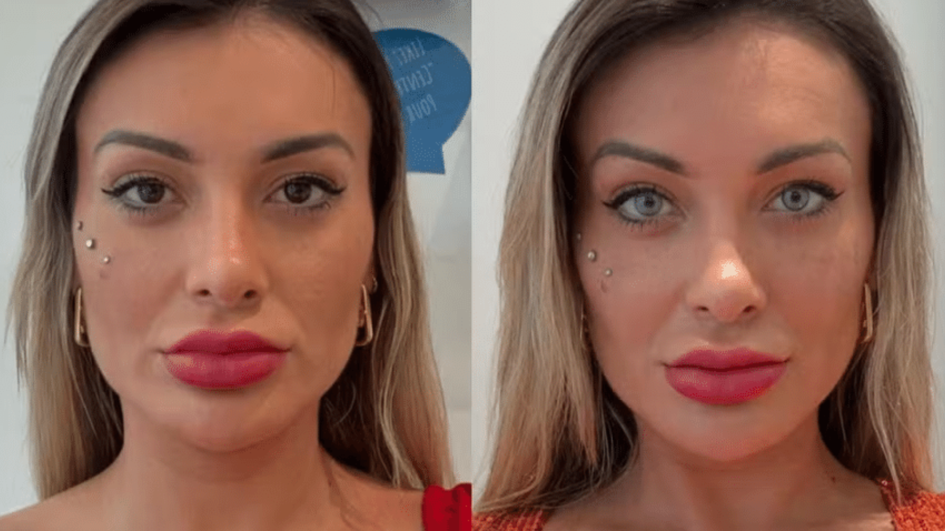 Andressa Urach sofre após mudar a cor dos olhos e médico faz alerta grave