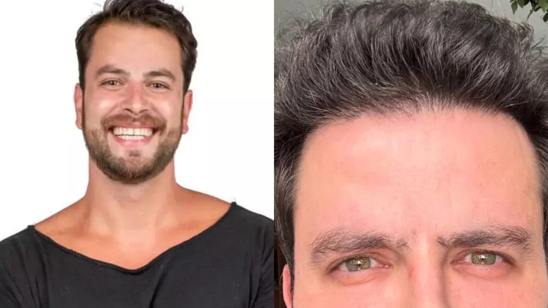 Ex-BBB Gustavo Marsengo faz procedimento estético e web não perdoa: ‘Vou melhorar’