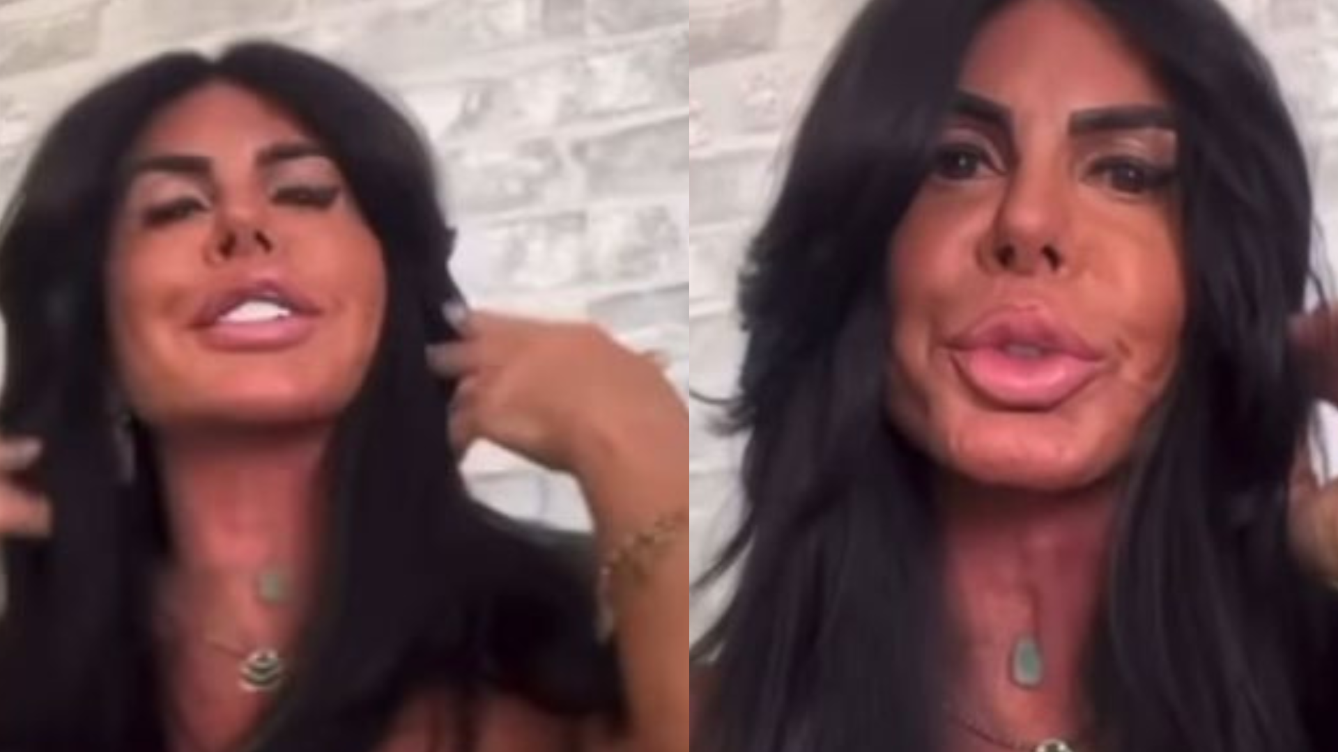 Gretchen faz novo procedimento no rosto e surpreende com o resultado: ‘Fininho’