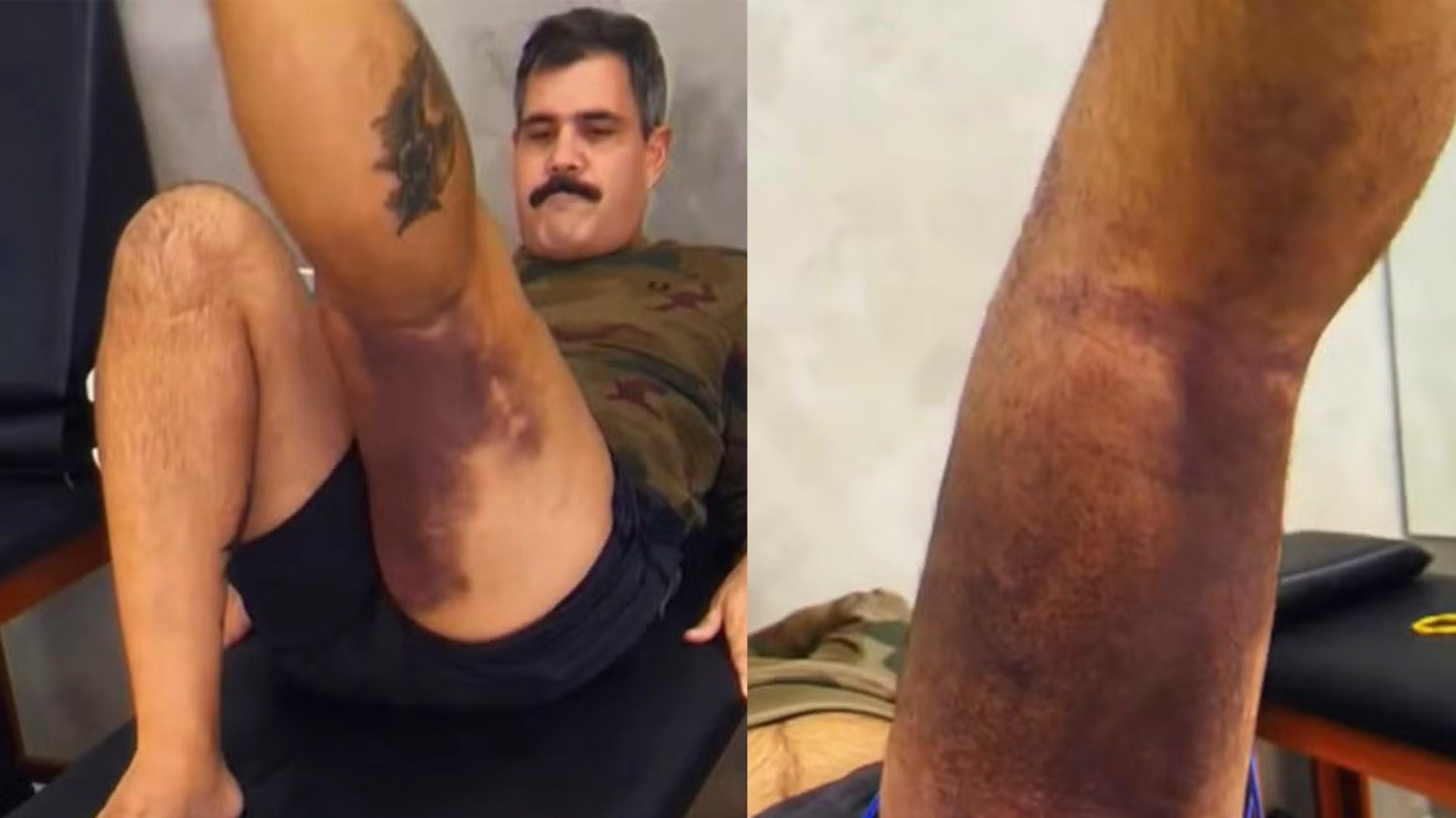 Juliano Cazarré exibe hematomas chocantes ao iniciar reabilitação após cirurgia no joelho
