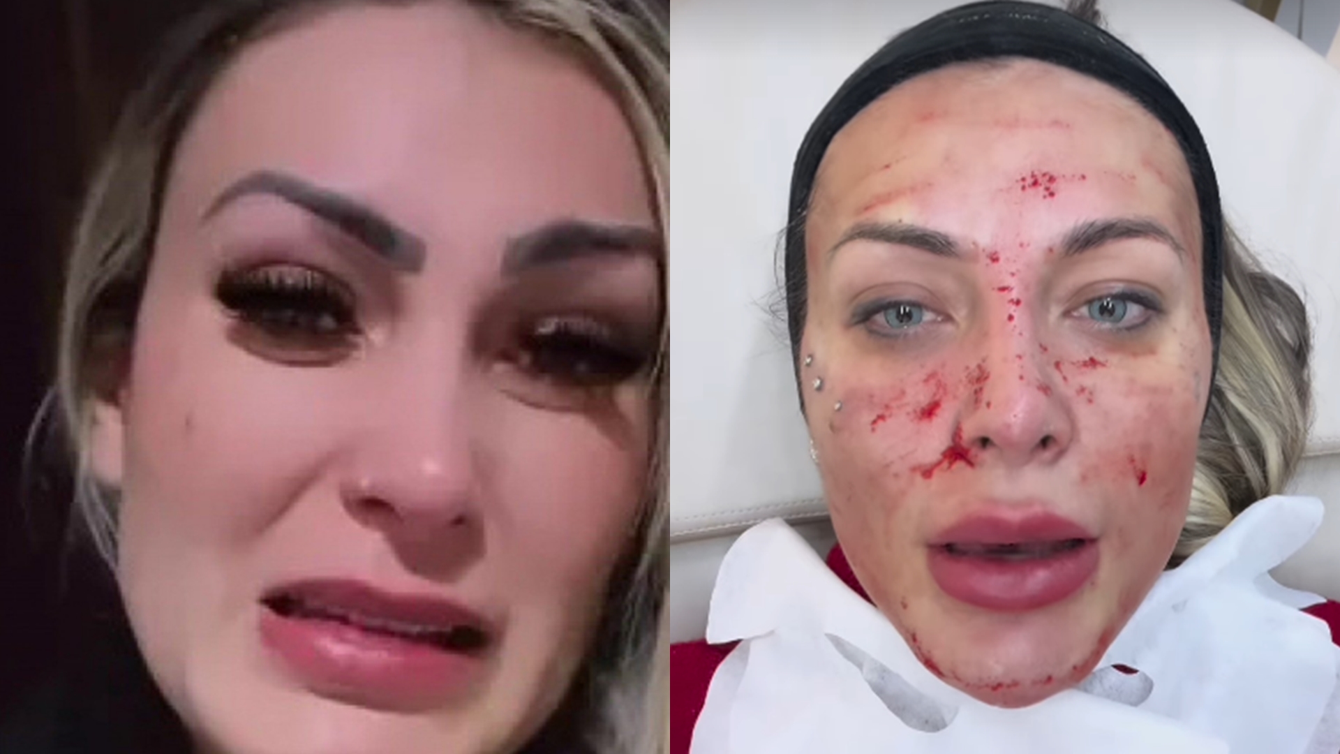 O que aconteceu? Andressa Urach assusta os fãs ao aparecer com o rosto cheio de sangue