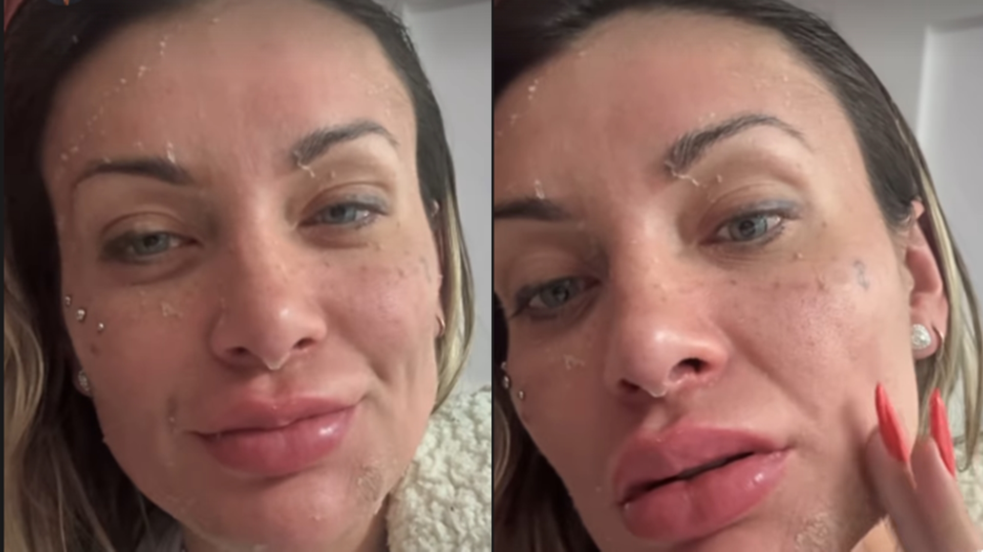De novo? Depois de sangue no rosto, Andressa Urach surge toda descascada: ‘Horrorosa’