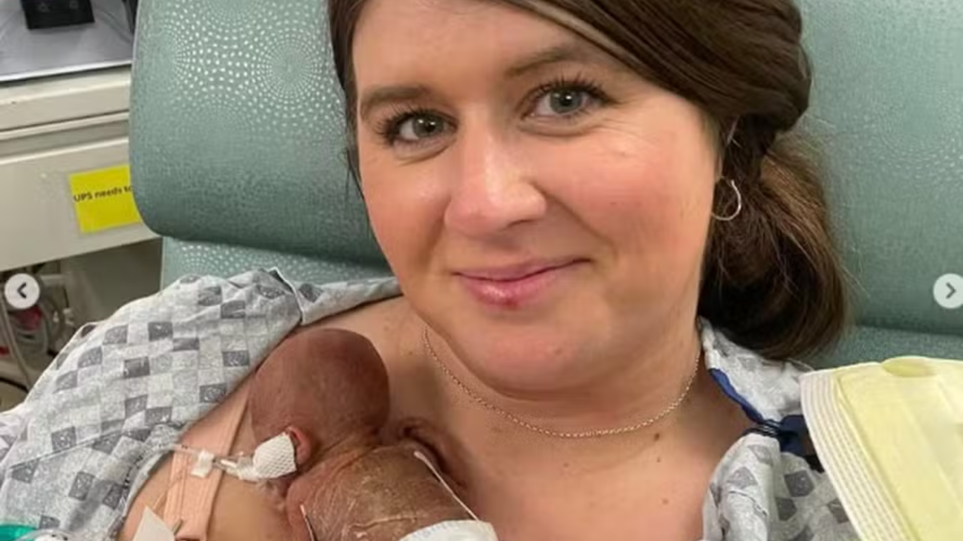 ‘Bebê mais prematuro do mundo’, nascido com 280g, completa 1 ano