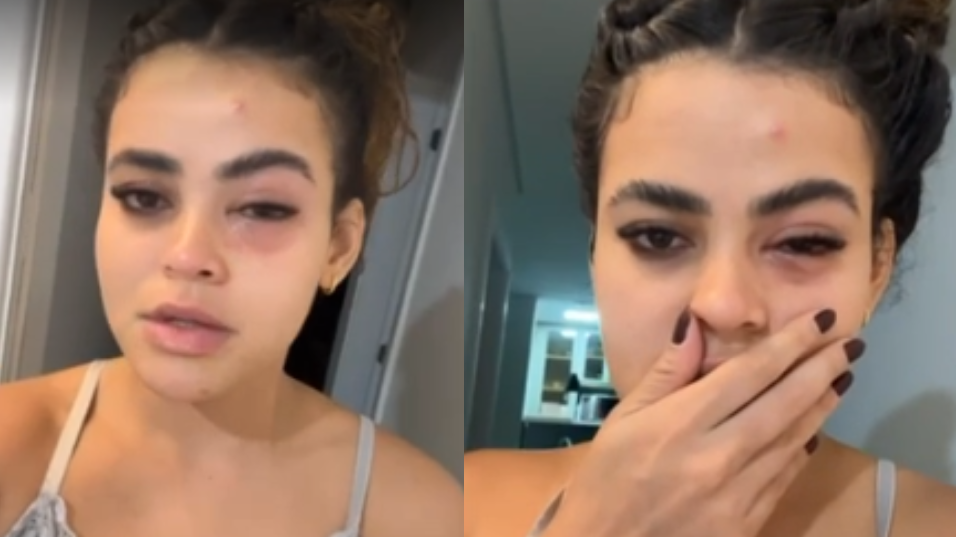 MEDO! Influenciadora pega infecção no olho após ser atingida por mosca de banheiro