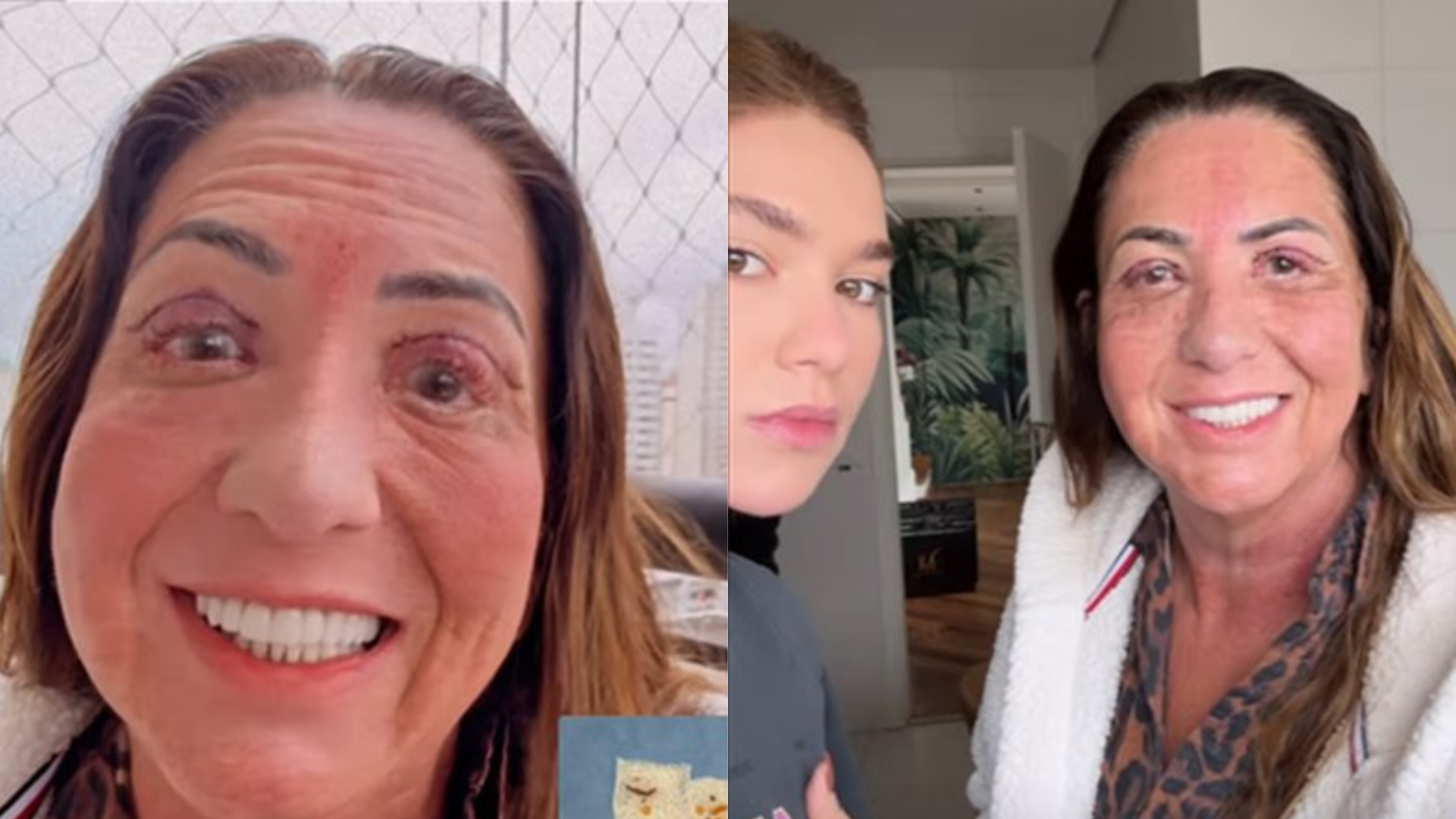 Mãe de Virginia faz cirurgia nos olhos e influenciadora choca web ao mostrar pele retirada: ‘Nojo’