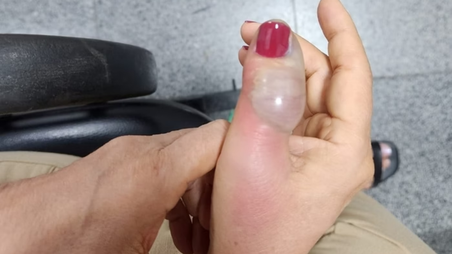 PERIGO! Mulher tem infecção após fazer as unhas e passa por 4 cirurgias