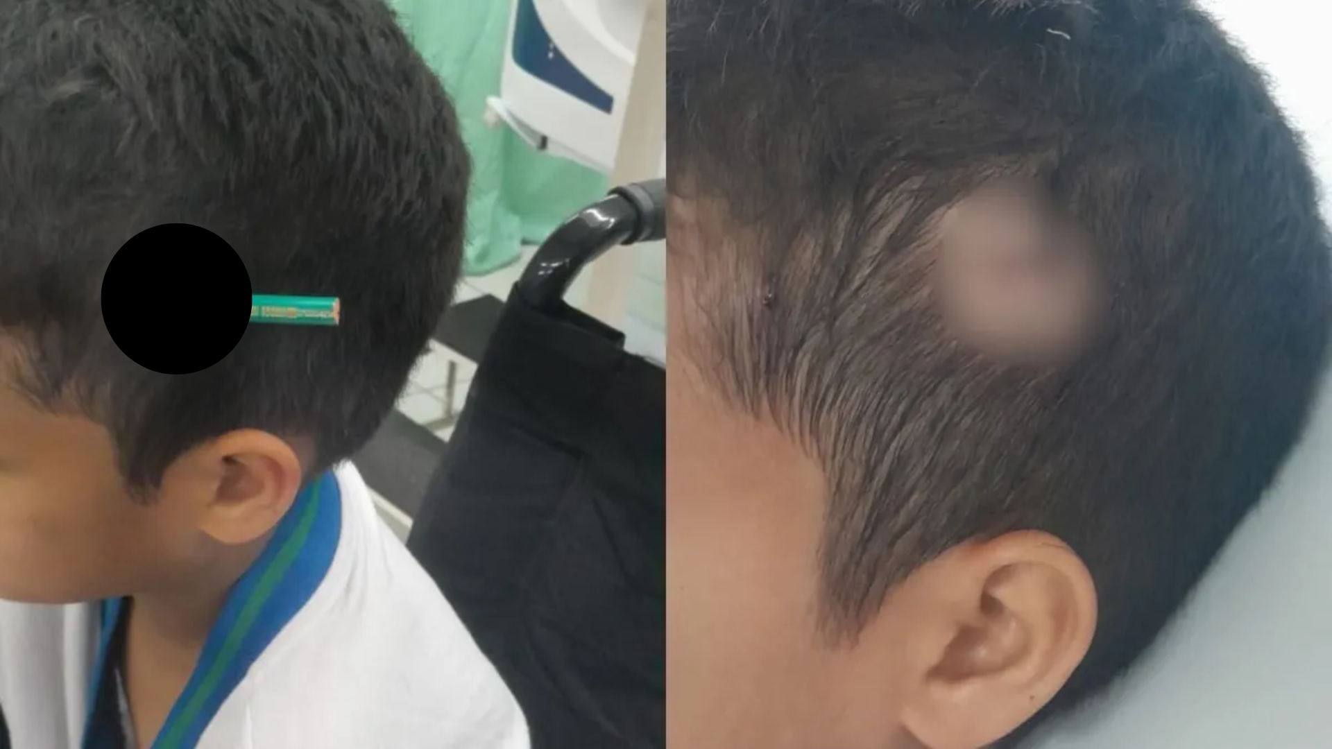 Criança fica com lápis cravado na cabeça após briga em escola de SP