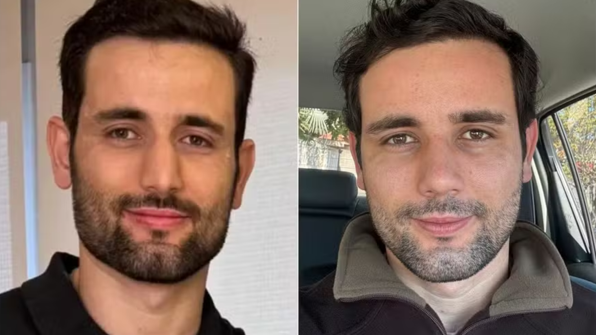 Ex-BBB Matteus Amaral reaparece após cirurgia no nariz e especialista comenta mudanças