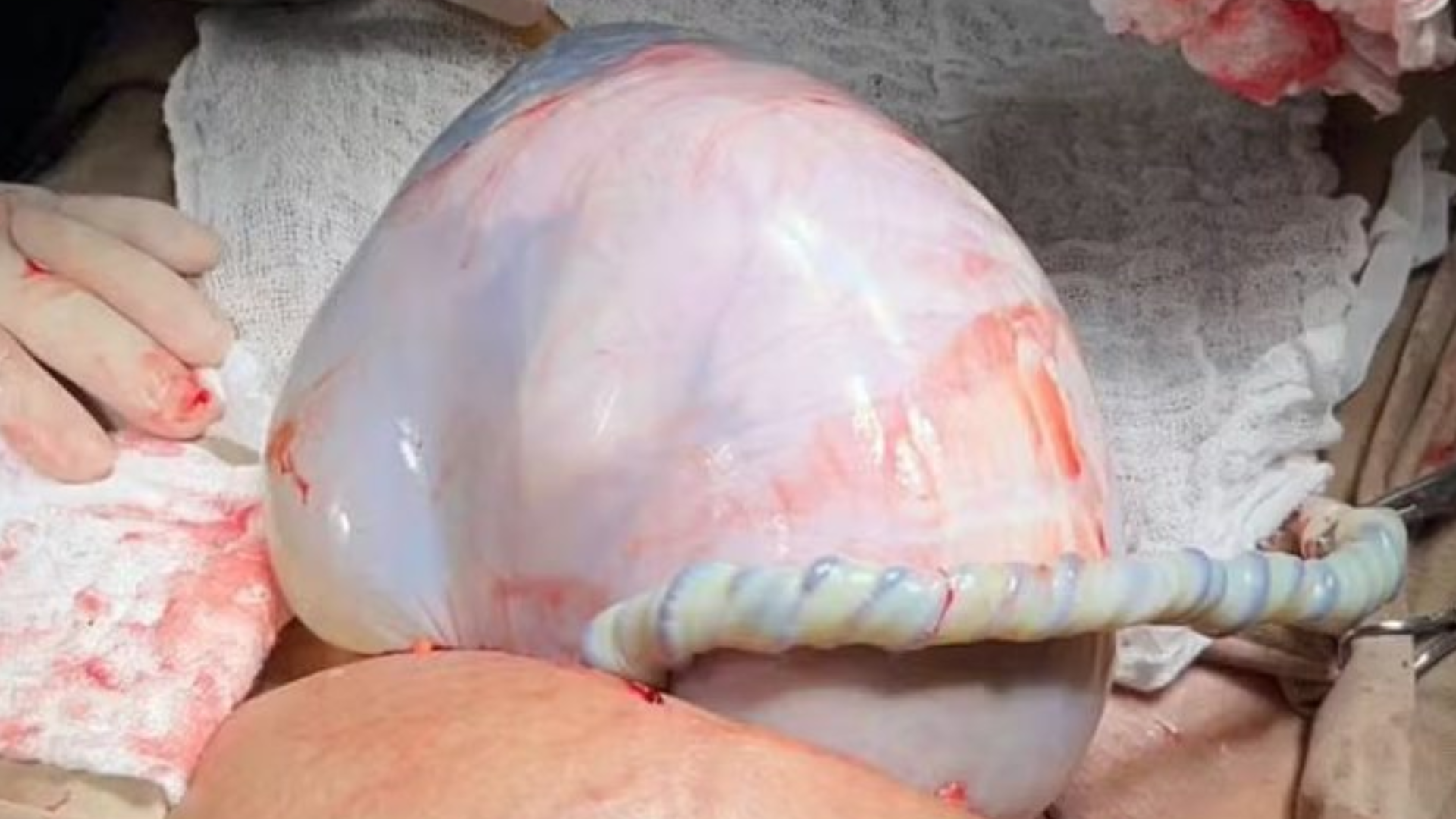 Gêmea nasce em bolsa de pele e médico esclarece fenômeno raro: ‘Acaso’
