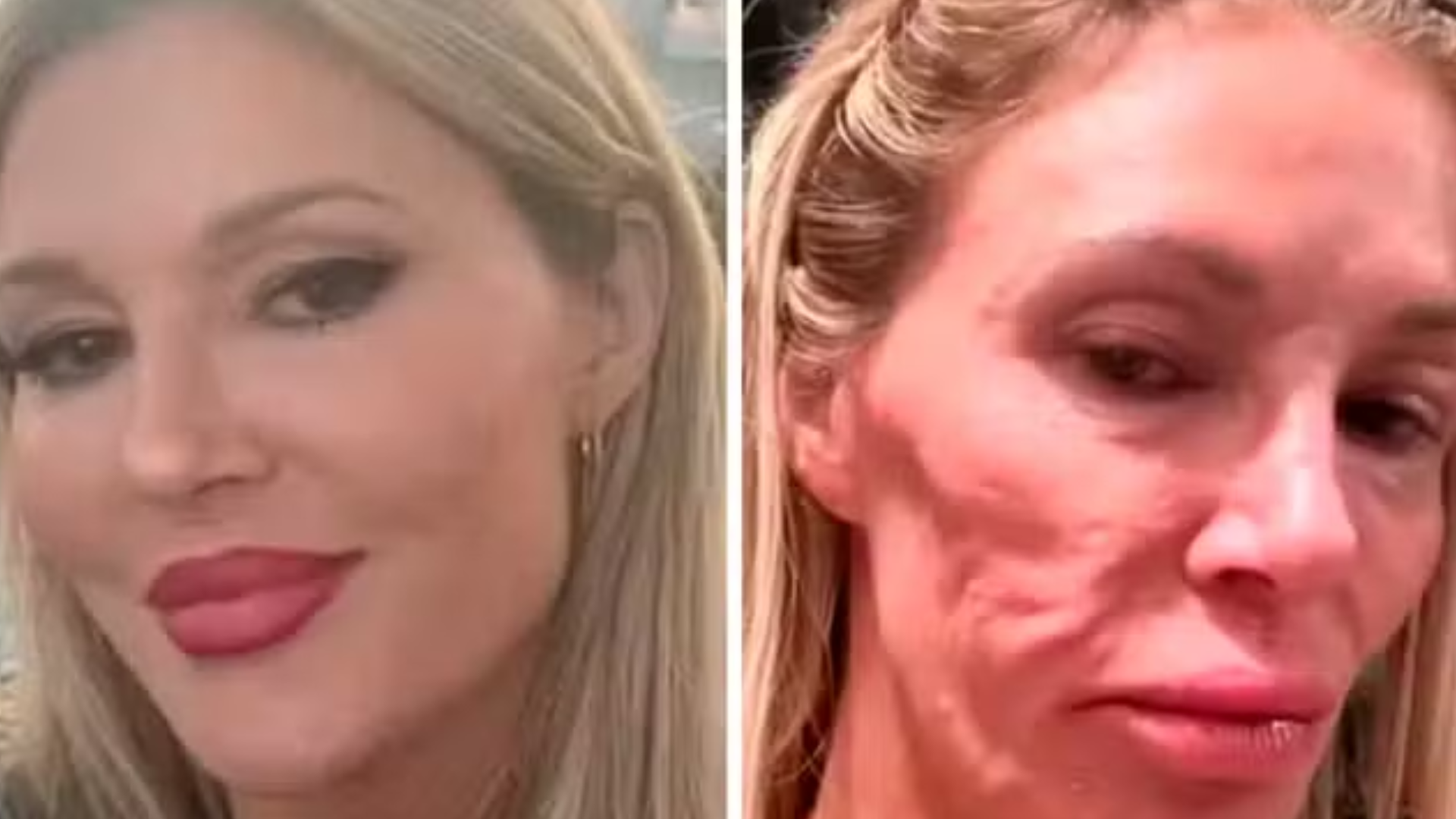 Ex-modelo sofre queimaduras graves ao tentar matar parasita que fez rosto ‘derreter’; antes e depois
