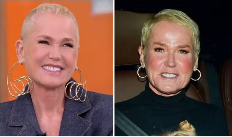 Cabelo de Xuxa após transplante capilar surpreende; veja o antes e depois