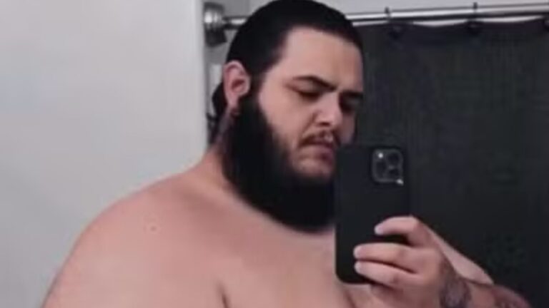 Influenciador retira excesso de pele após perder 150kg; veja o antes e depois