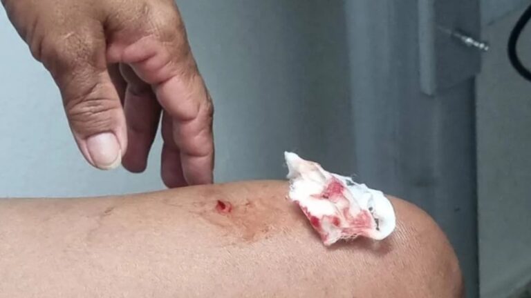 Imagens fortes! Mulher sofre ataque de macaco-prego em parque e é mordida na perna