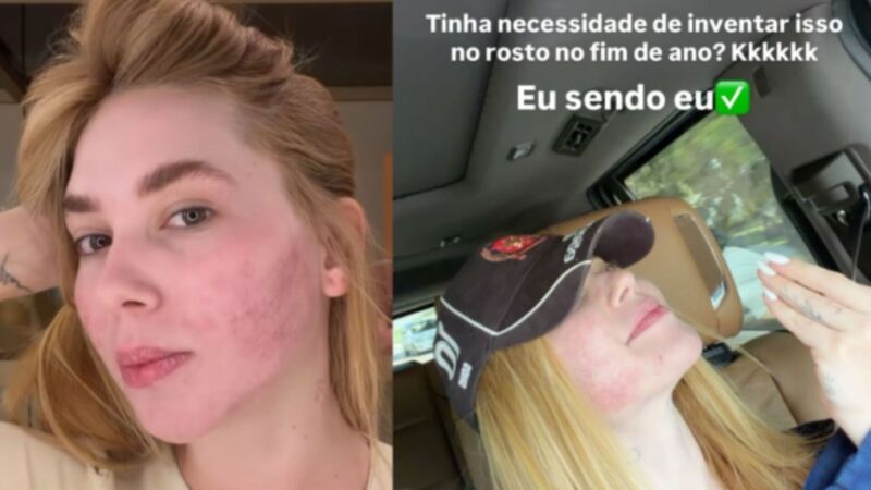Virginia abre o jogo sobre procedimento que deixou a pele do rosto irritada: ‘Tinha necessidade?’