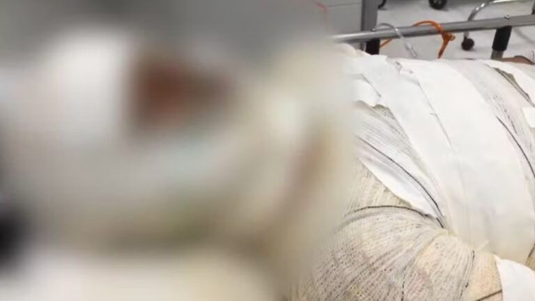 Adolescente é brutalmente espancada e queimada; suspeita é de transfobia
