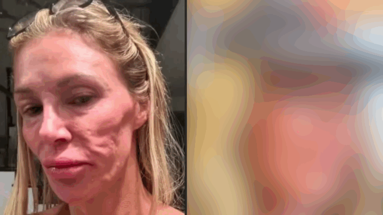 UAU! Influenciadora que teve rosto ‘derretido’ mostra como está após várias cirurgias