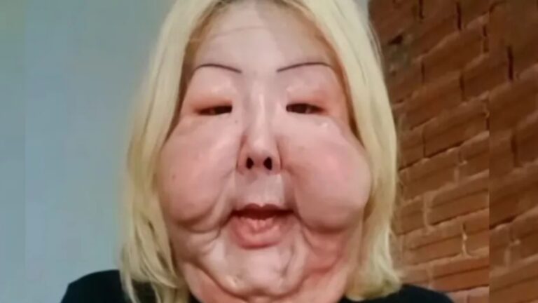 Seis meses após cirurgia delicada, Juju do Pix choca com evolução em processo de reconstrução facial