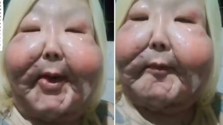 Juju do Pix enfrenta problema em cicatriz após cirurgia para remover óleo mineral do rosto