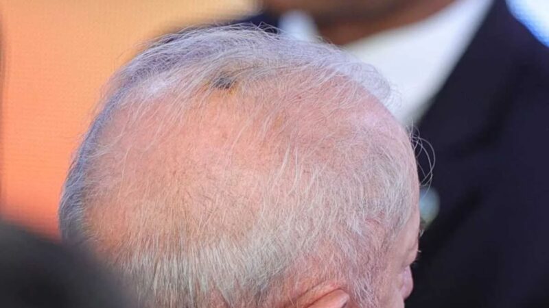 Lula após procedimento - Reprodução