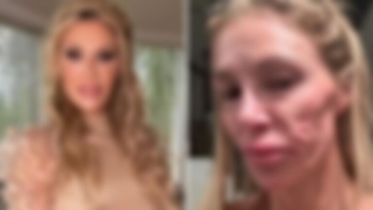 Influenciadora descobre causa de parasita que deformou seu rosto: ‘Aprendi uma lição difícil’
