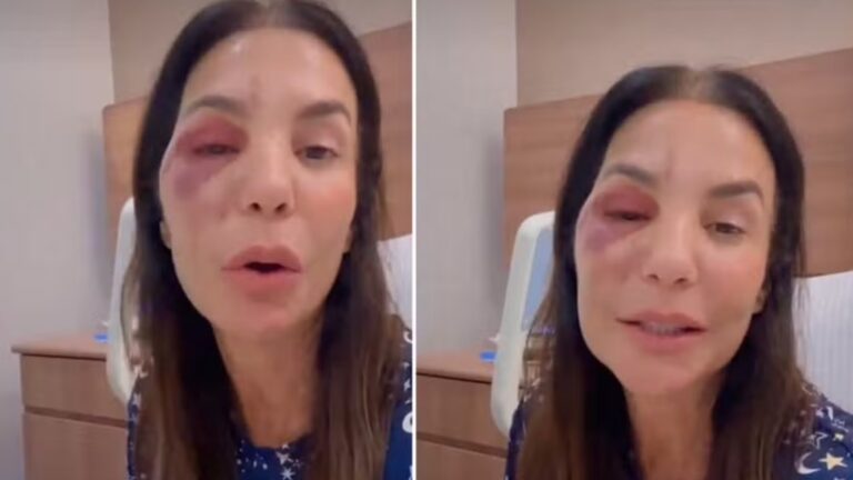 VÍDEO: Ivete Sangalo detalha cirurgia facial após acidente doméstico: ‘Quebrei dois ossos’
